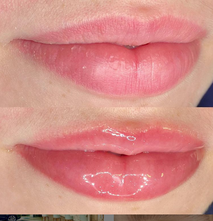 Collageen Lip Therapie Cursus en BB Lips Collageen Lip Therapie Cursus en BB Lips