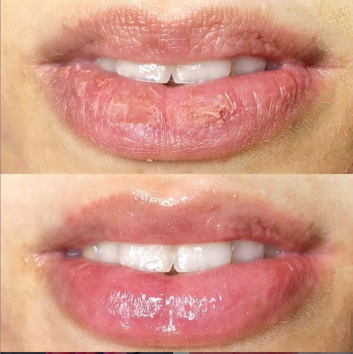 Collageen Lip Therapie Cursus en BB Lips Collageen Lip Therapie Cursus en BB Lips