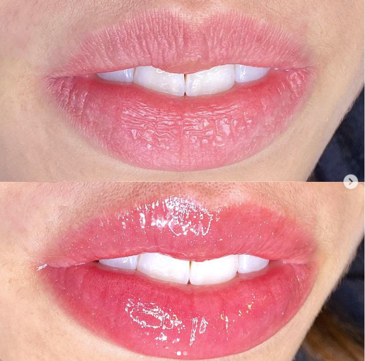 Collageen Lip Therapie Cursus en BB Lips Collageen Lip Therapie Cursus en BB Lips